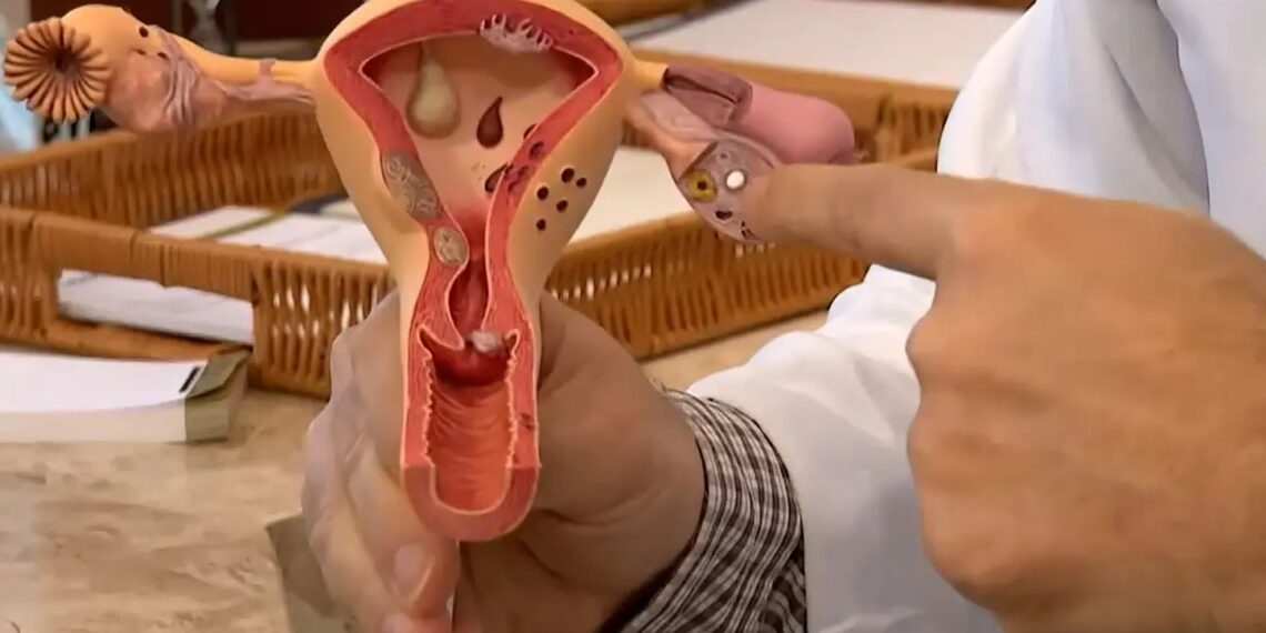 Conheça os sintomas da endometriose e saiba como tratar a doença