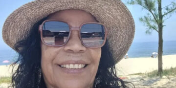 Vilma Nascimento abre o jogo sobre sua luta contra o Melasma