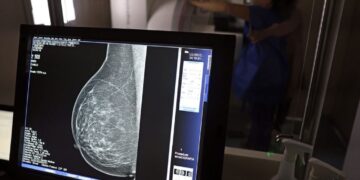 Ministério da Saúde passa a recomendar mamografia a partir dos 40 anos