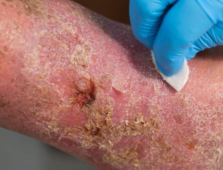 Amputações por diabetes seguem em alta no Brasil e preocupam especialistas