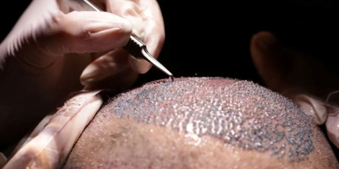 Transplante capilar cresce entre homens e vira símbolo de autoestima e bem-estar