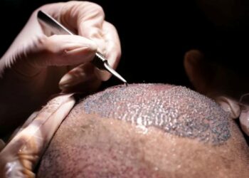 Transplante capilar cresce entre homens e vira símbolo de autoestima e bem-estar