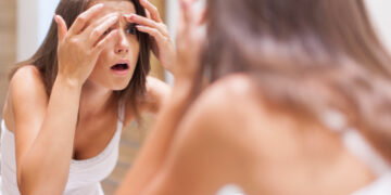 Ciclo menstrual irregular aumenta risco de acne, melasma e manchas na pele, aponta estudo